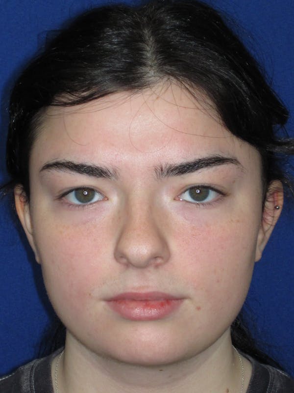 Rhinoplasty Before & After Gallery - Patient 244407 - Image 1