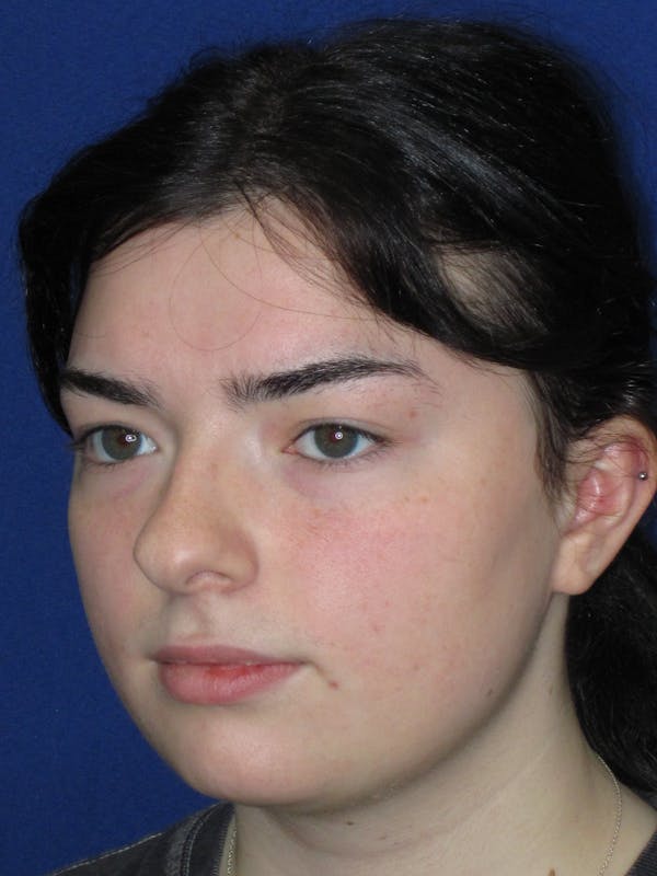 Rhinoplasty Before & After Gallery - Patient 244407 - Image 5