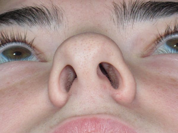 Rhinoplasty Before & After Gallery - Patient 244407 - Image 7