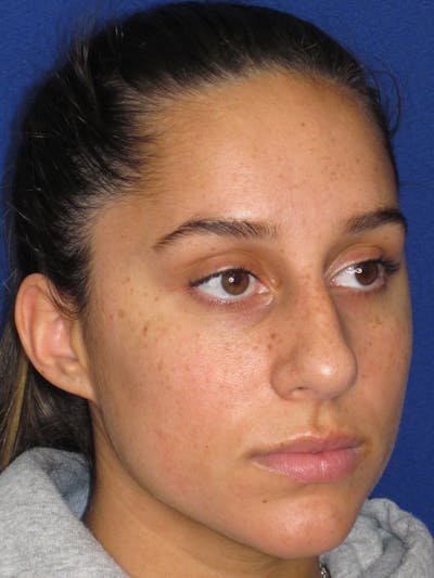 Rhinoplasty Before & After Gallery - Patient 256913 - Image 1