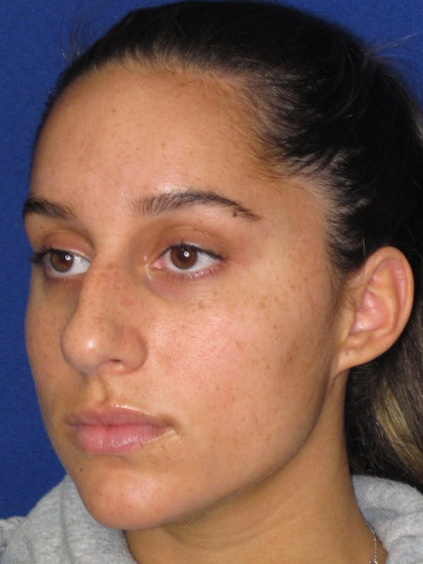 Rhinoplasty Before & After Gallery - Patient 256913 - Image 7