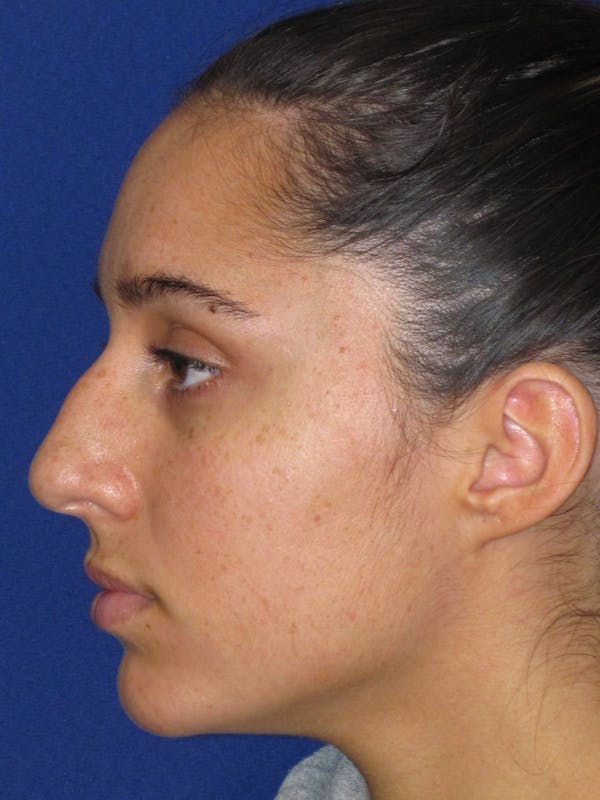 Rhinoplasty Before & After Gallery - Patient 256913 - Image 9