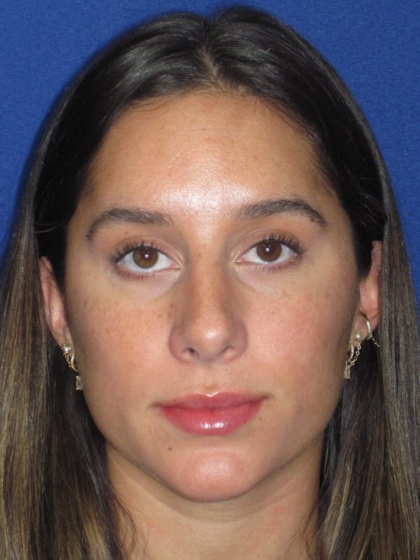 Rhinoplasty Before & After Gallery - Patient 256913 - Image 4