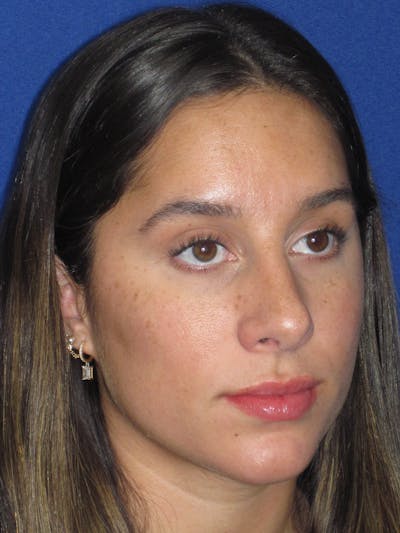 Rhinoplasty Before & After Gallery - Patient 256913 - Image 2