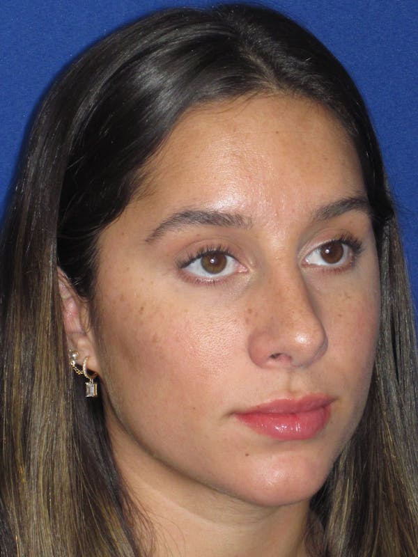 Rhinoplasty Before & After Gallery - Patient 256913 - Image 2