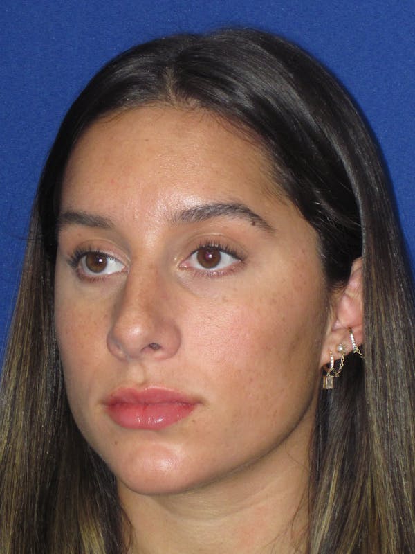 Rhinoplasty Before & After Gallery - Patient 256913 - Image 8