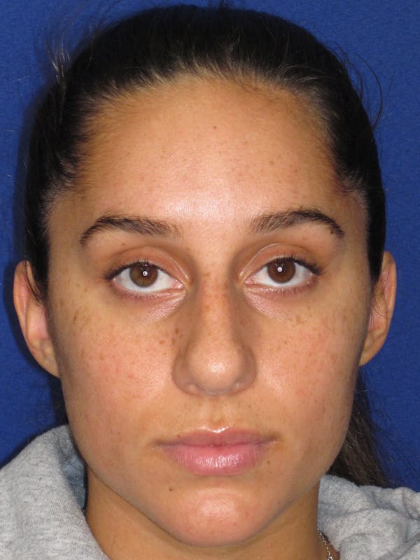 Rhinoplasty Before & After Gallery - Patient 256913 - Image 3