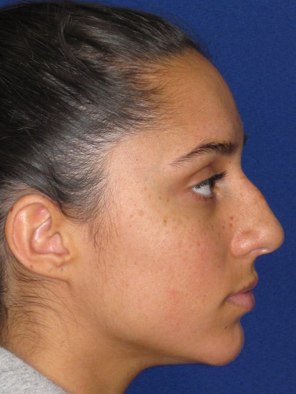Rhinoplasty Before & After Gallery - Patient 256913 - Image 5