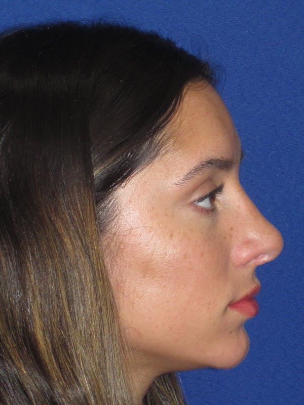 Rhinoplasty Before & After Gallery - Patient 256913 - Image 6