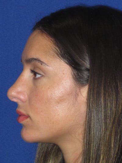 Rhinoplasty Before & After Gallery - Patient 256913 - Image 10