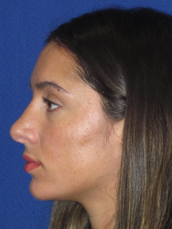 Rhinoplasty Before & After Gallery - Patient 256913 - Image 10