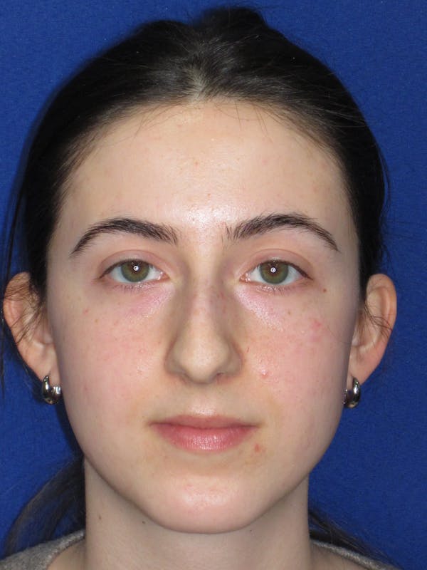 Rhinoplasty Before & After Gallery - Patient 280403 - Image 3