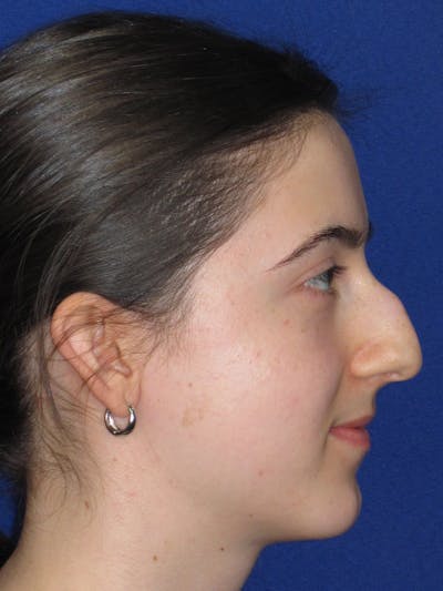 Rhinoplasty Before & After Gallery - Patient 280403 - Image 1