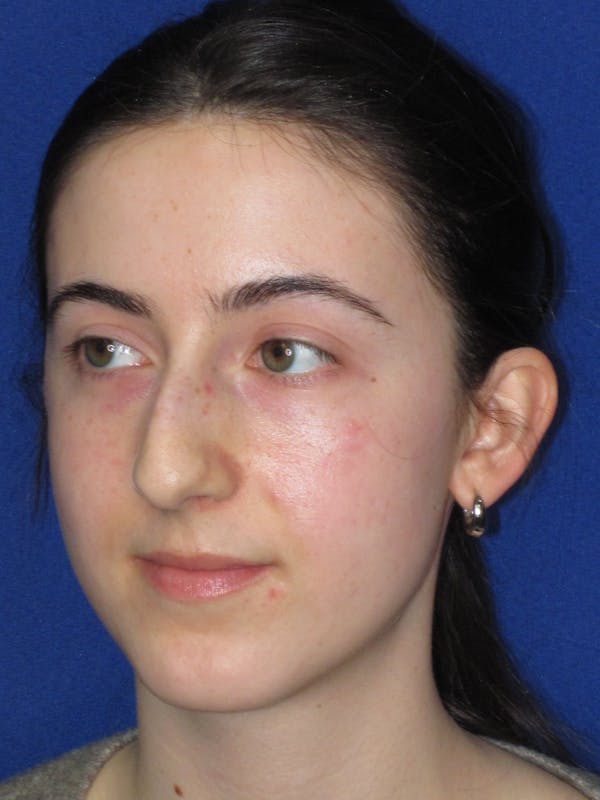 Rhinoplasty Before & After Gallery - Patient 280403 - Image 9