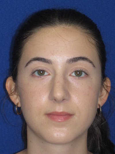Rhinoplasty Before & After Gallery - Patient 280403 - Image 4