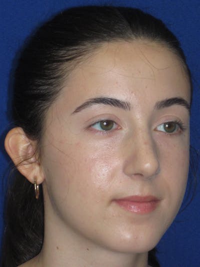 Rhinoplasty Before & After Gallery - Patient 280403 - Image 6