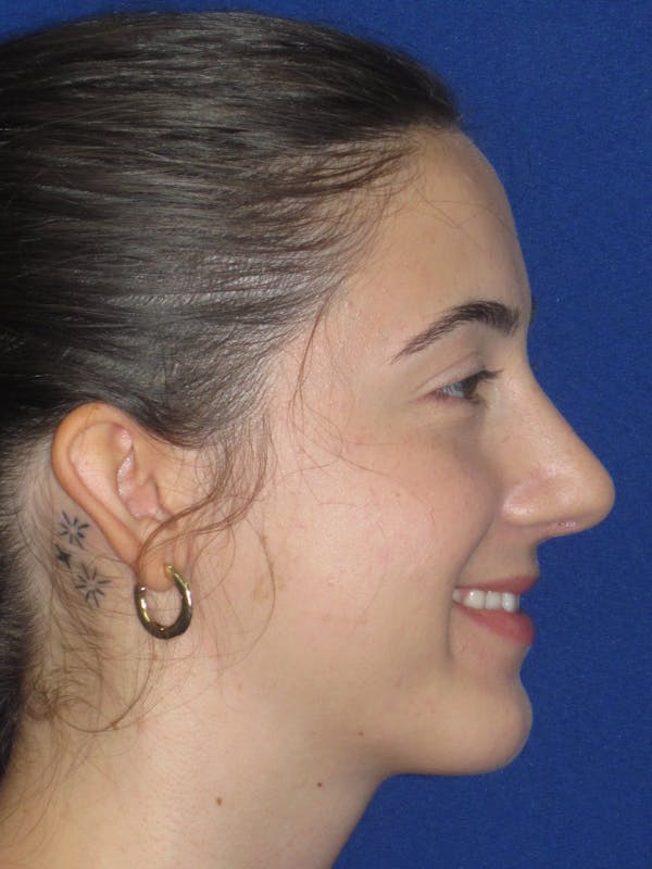 Rhinoplasty Before & After Gallery - Patient 280403 - Image 2