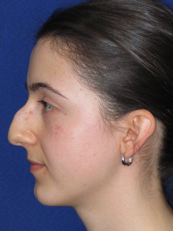 Rhinoplasty Before & After Gallery - Patient 280403 - Image 11