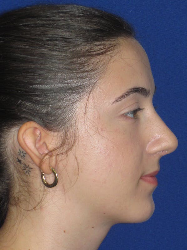 Rhinoplasty Before & After Gallery - Patient 280403 - Image 8