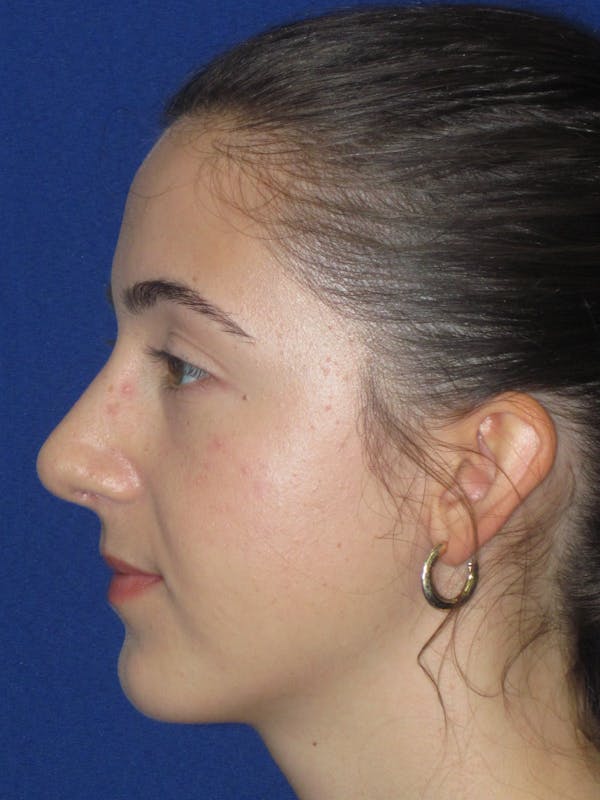 Rhinoplasty Before & After Gallery - Patient 280403 - Image 12