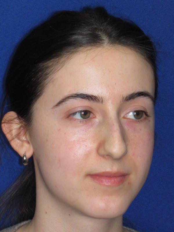 Rhinoplasty Before & After Gallery - Patient 280403 - Image 5