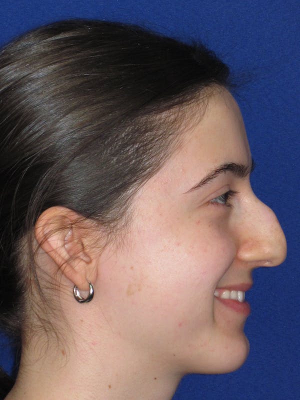 Rhinoplasty Before & After Gallery - Patient 280403 - Image 7