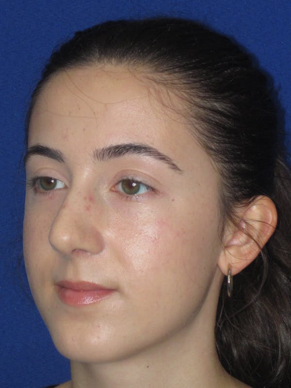 Rhinoplasty Before & After Gallery - Patient 280403 - Image 10
