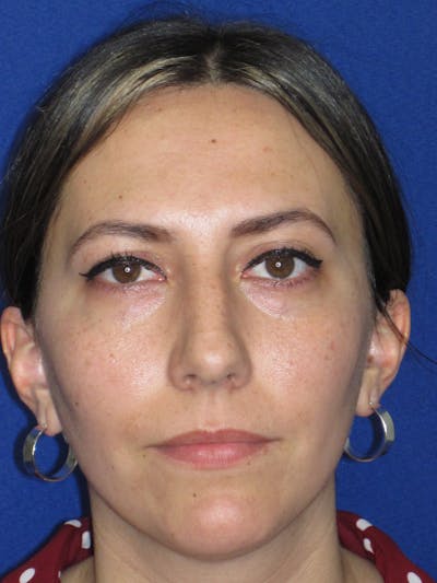Rhinoplasty Before & After Gallery - Patient 974003 - Image 1