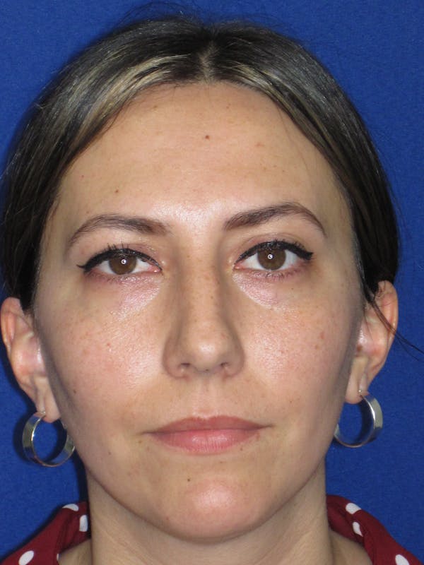 Rhinoplasty Before & After Gallery - Patient 974003 - Image 1