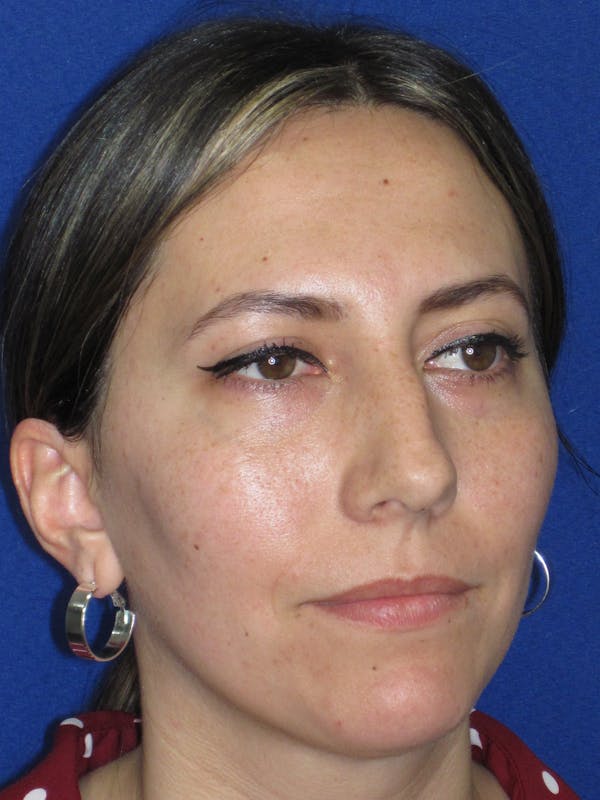 Rhinoplasty Before & After Gallery - Patient 974003 - Image 5