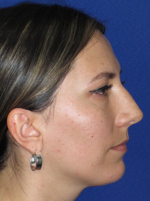 Rhinoplasty Before & After Gallery - Patient 974003 - Image 7