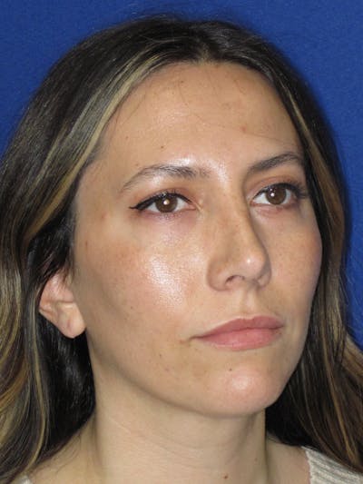 Rhinoplasty Before & After Gallery - Patient 974003 - Image 6