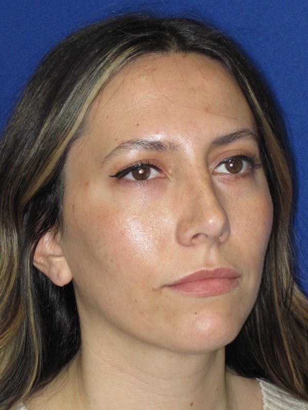 Rhinoplasty Before & After Gallery - Patient 974003 - Image 6