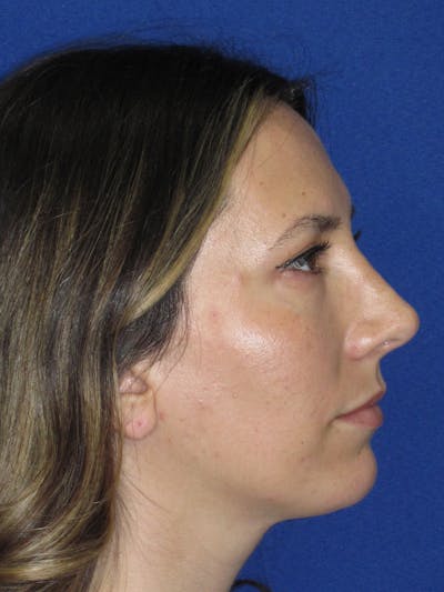 Rhinoplasty Before & After Gallery - Patient 974003 - Image 8