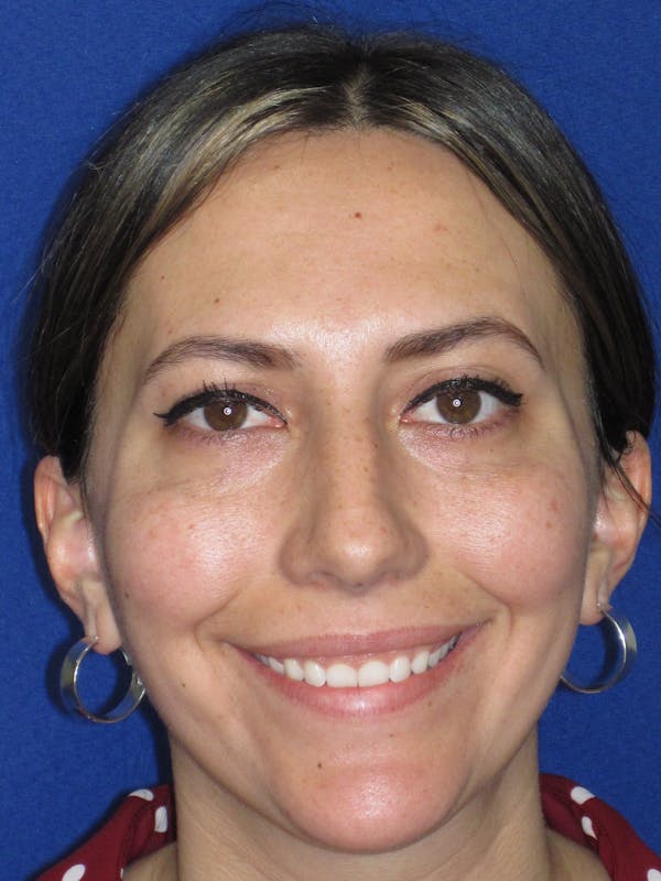 Rhinoplasty Before & After Gallery - Patient 974003 - Image 3