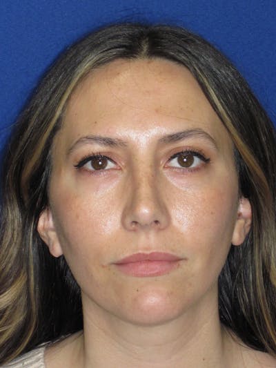 Rhinoplasty Before & After Gallery - Patient 974003 - Image 2