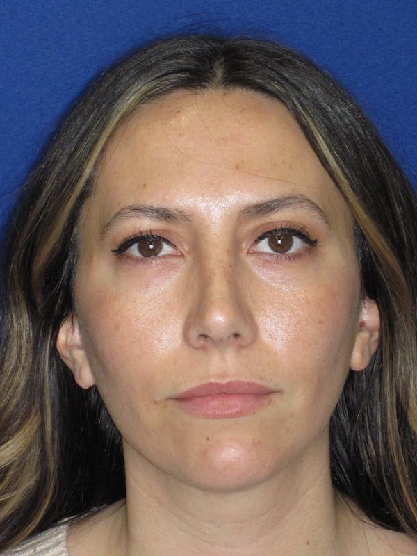 Rhinoplasty Before & After Gallery - Patient 974003 - Image 2