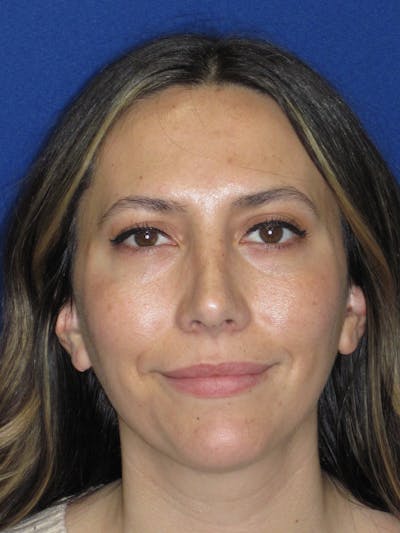 Rhinoplasty Before & After Gallery - Patient 974003 - Image 4