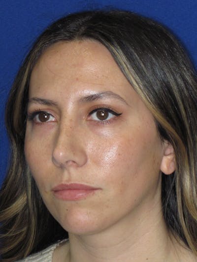 Rhinoplasty Before & After Gallery - Patient 974003 - Image 10
