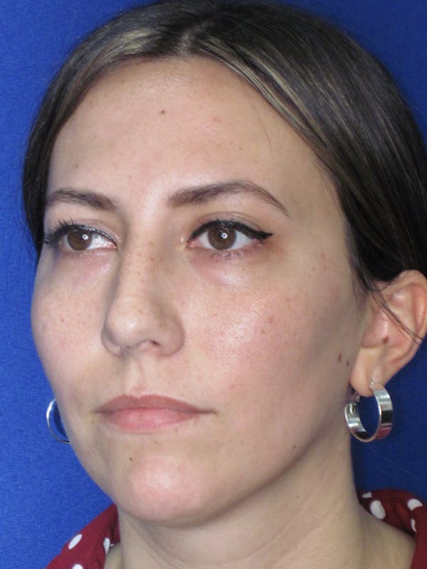 Rhinoplasty Before & After Gallery - Patient 974003 - Image 9
