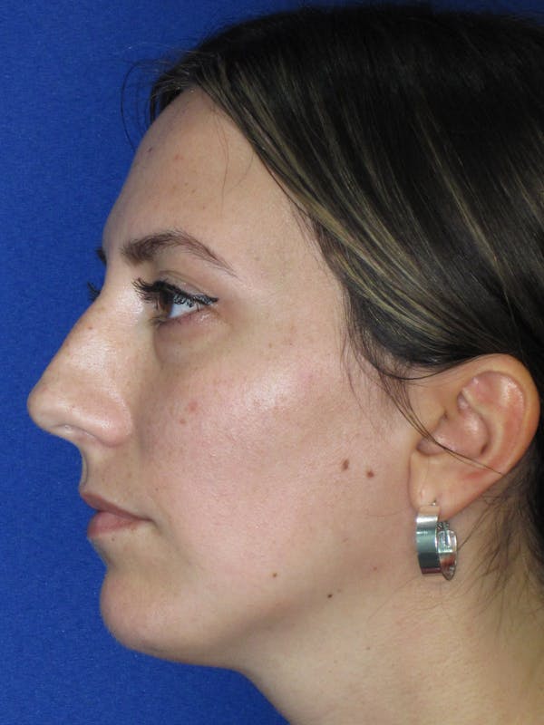 Rhinoplasty Before & After Gallery - Patient 974003 - Image 11
