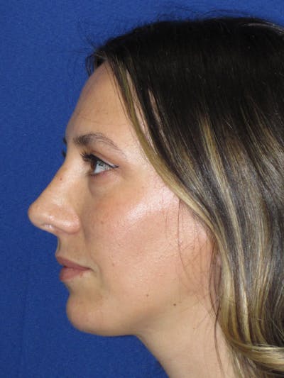 Rhinoplasty Before & After Gallery - Patient 974003 - Image 12