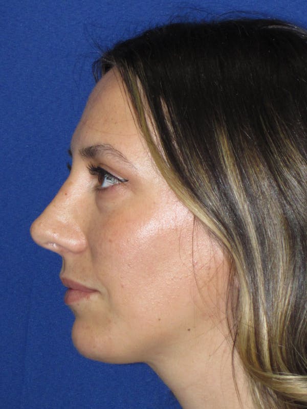 Rhinoplasty Before & After Gallery - Patient 974003 - Image 12
