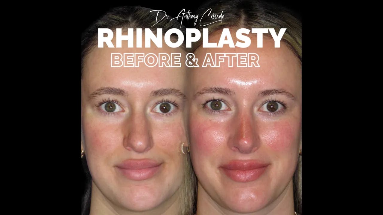 3 Months & She's Glowing: Rhinoplasty Before & After