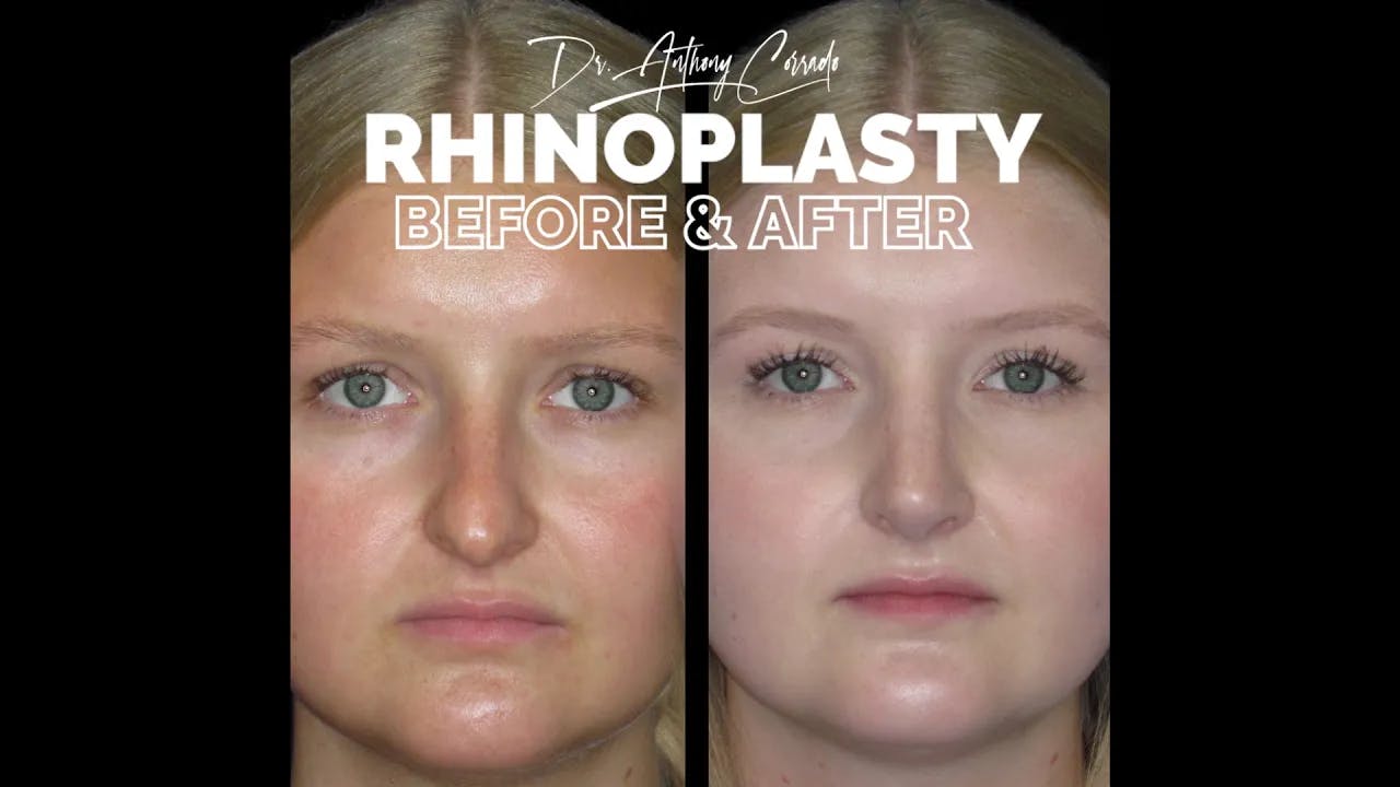 Unbelievable Rhinoplasty Transformation: Before & After Reveal