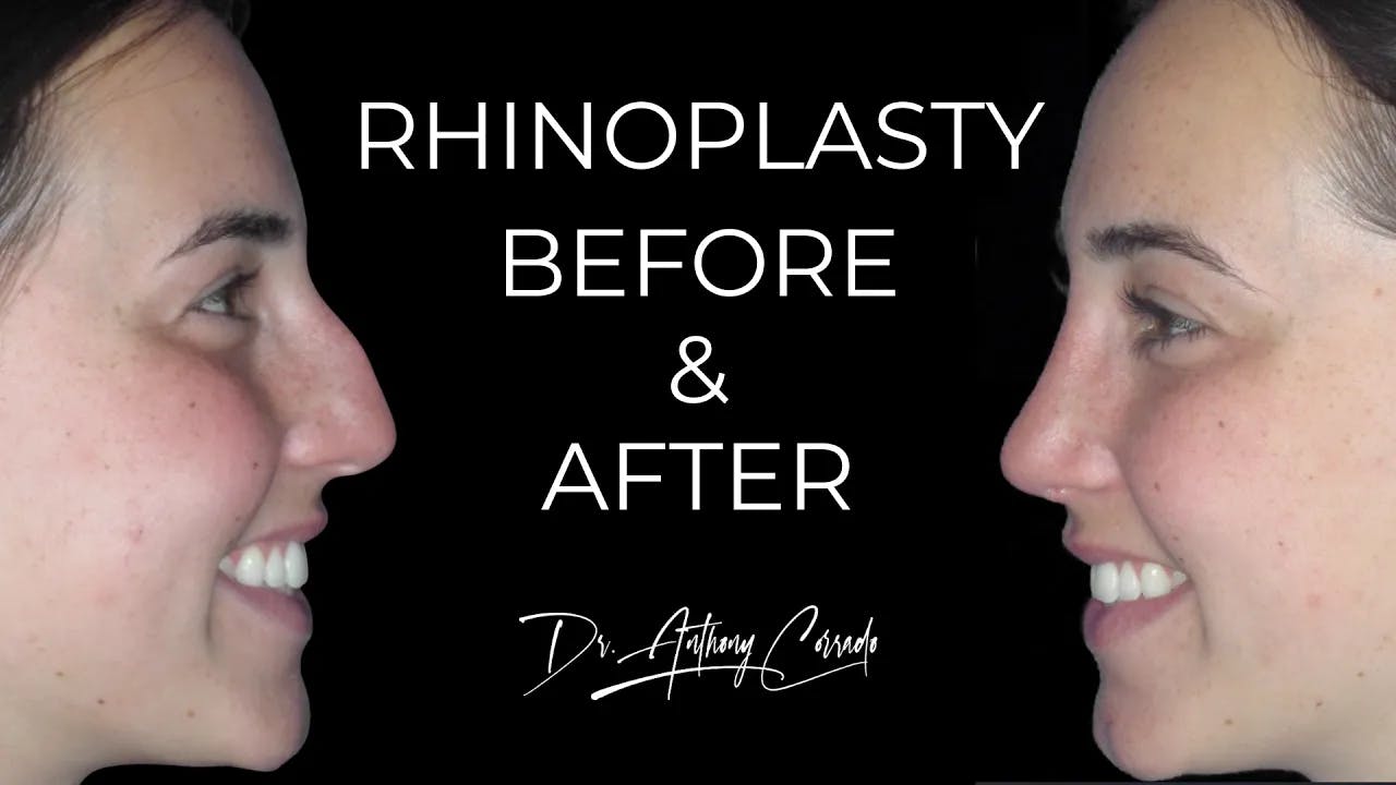 Female Rhinoplasty Before & After: Dorsal Hump & Plunging Tip Corrected