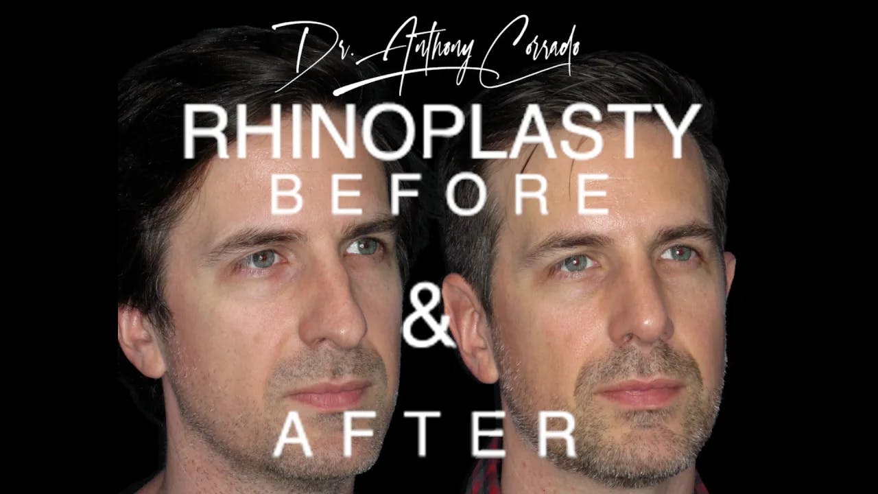 Male Rhinoplasty Before & After: Wide Tip, Dorsal Hump & Irregularities Corrected