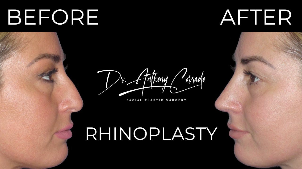 Stunning Rhinoplasty Results: Before & After Transformation