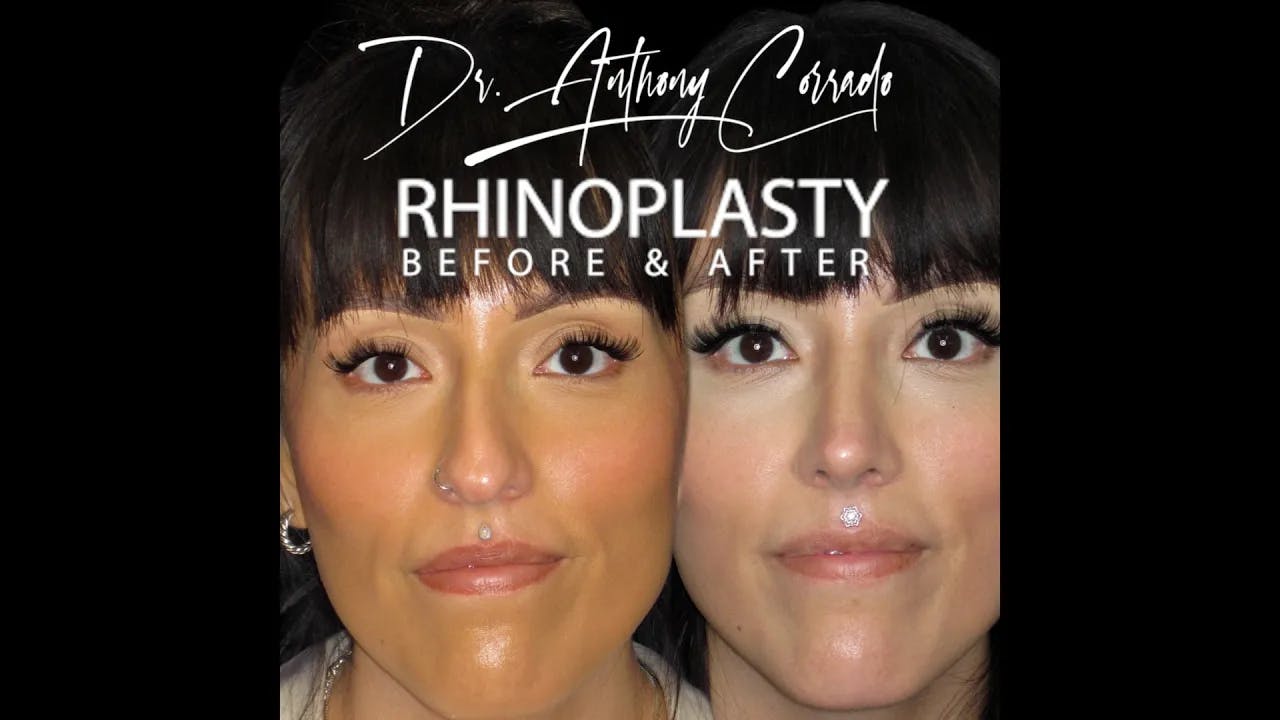 Dorsal Hump, Droopy & Asymmetric Tip: Beautifully Transformed Rhinoplasty
