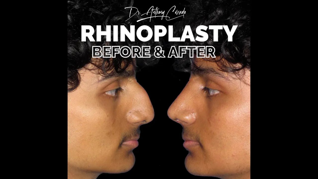 Ethnic Male Rhinoplasty Before & After: Natural & Masculine Results